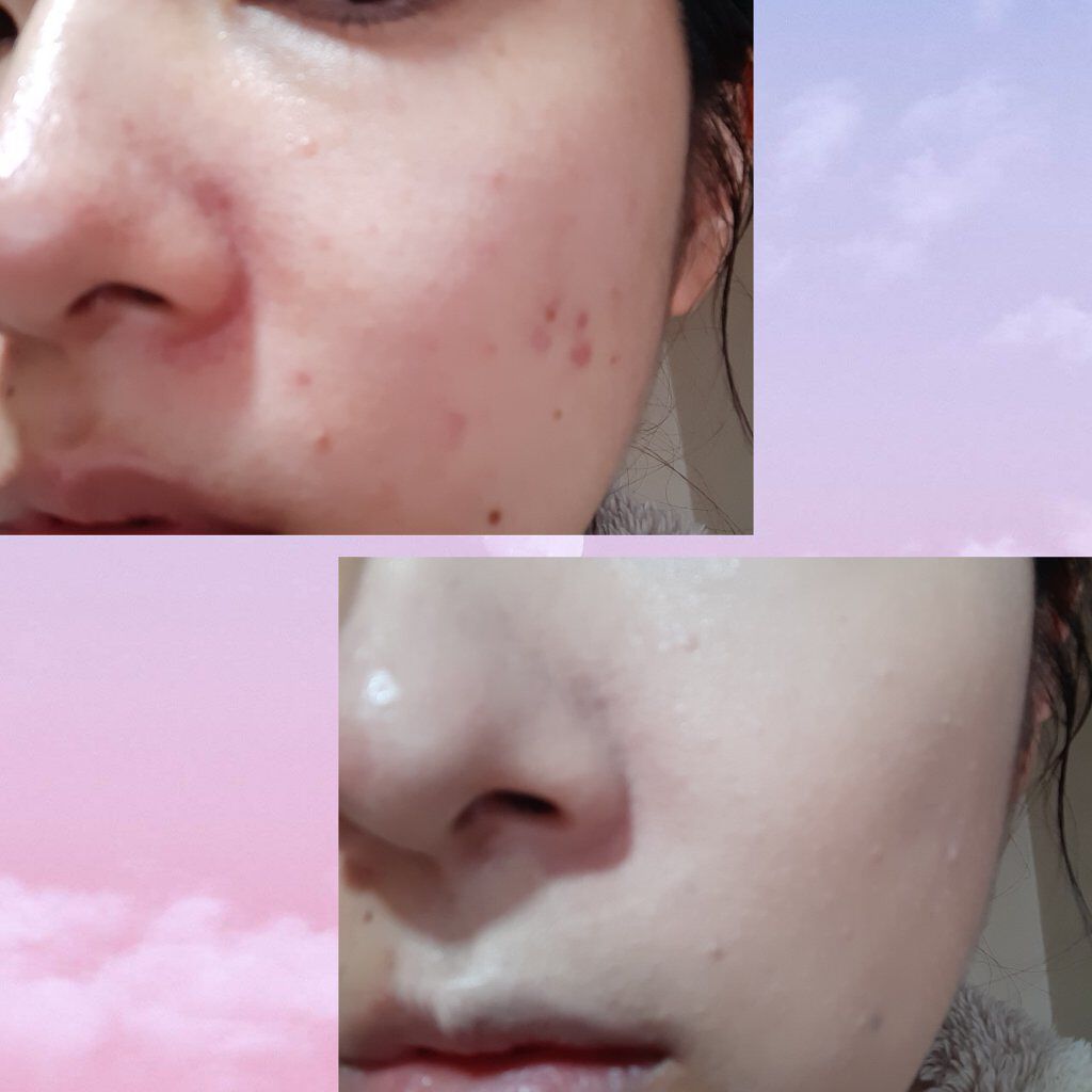 ピンクティーツリーカバークッション/APLIN/クッションファンデーションを使ったクチコミ(5枚目)