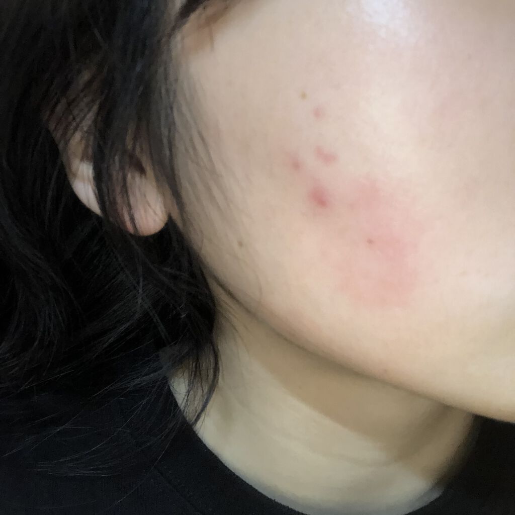 ペアアクネクリームW(医薬品)/ペア/その他を使ったクチコミ（2枚目）