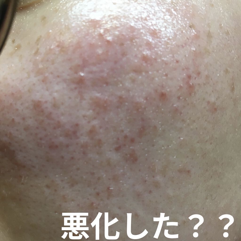 モイスト トリートメント ジェル/アルージェ/美容液を使ったクチコミ（1枚目）