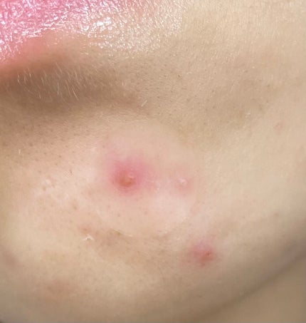 極薄透明パッチ nikipa!/金冠堂/にきびパッチを使ったクチコミ(5枚目)