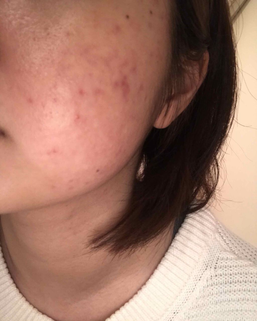 ペアアクネクリームW(医薬品)/ペア/その他を使ったクチコミ（3枚目）