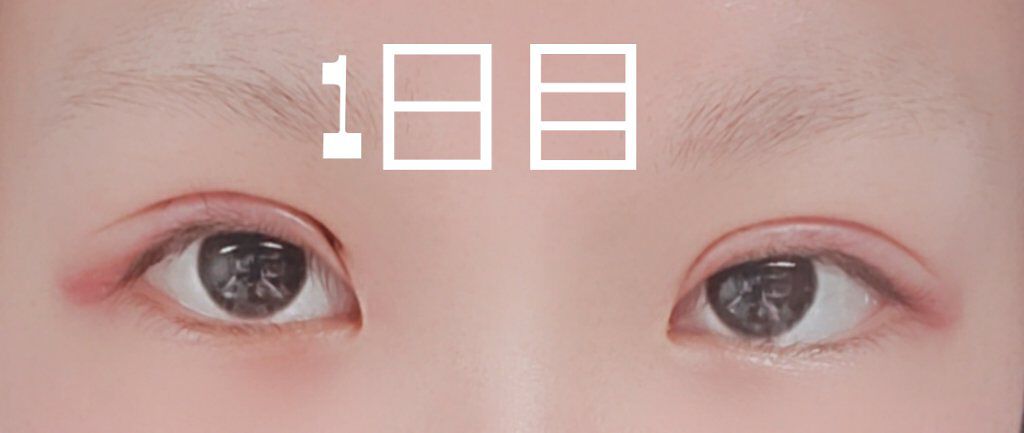 二重整形/その他を使ったクチコミ（2枚目）