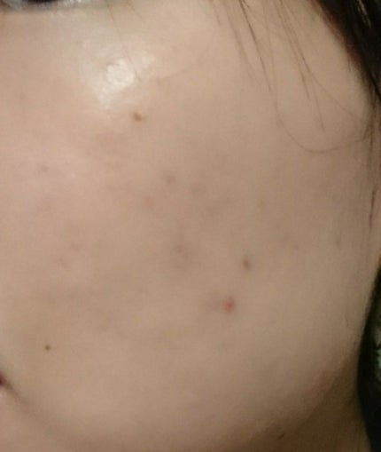 Nexcare/3M nexcare/にきびパッチを使ったクチコミ(3枚目)