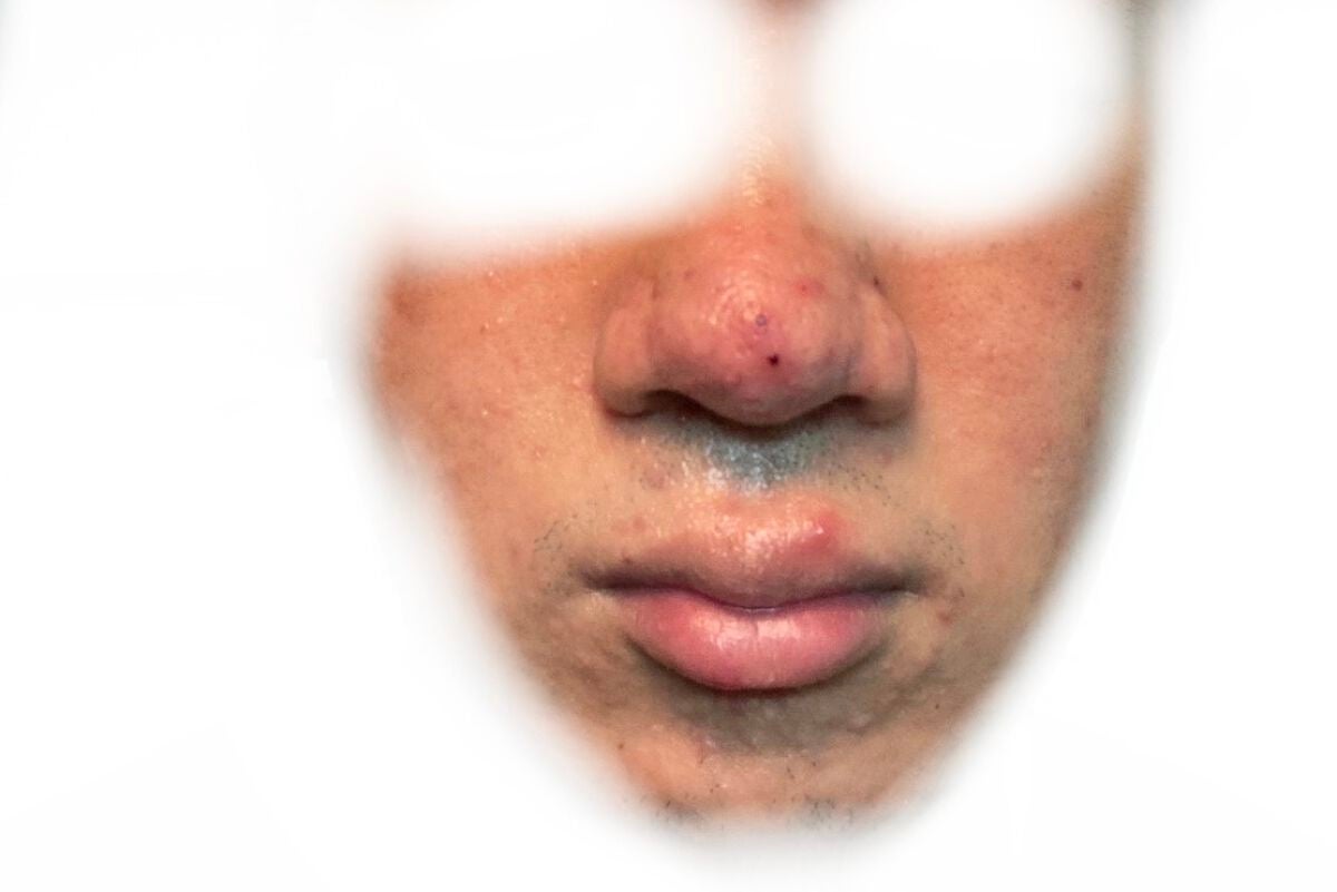 (フォロバ)3年後に韓国美男子 on LIPS 「CICA×HYALONフェスパック最終レビュー1ヶ月の経過写真..」(7枚目)