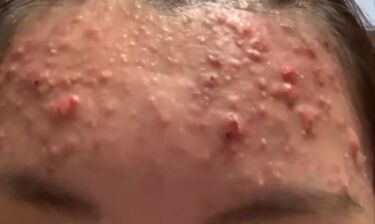 22年最新 ニキビ跡 皮膚科 おすすめ特集 口コミで人気の50アイテムを紹介 Lips