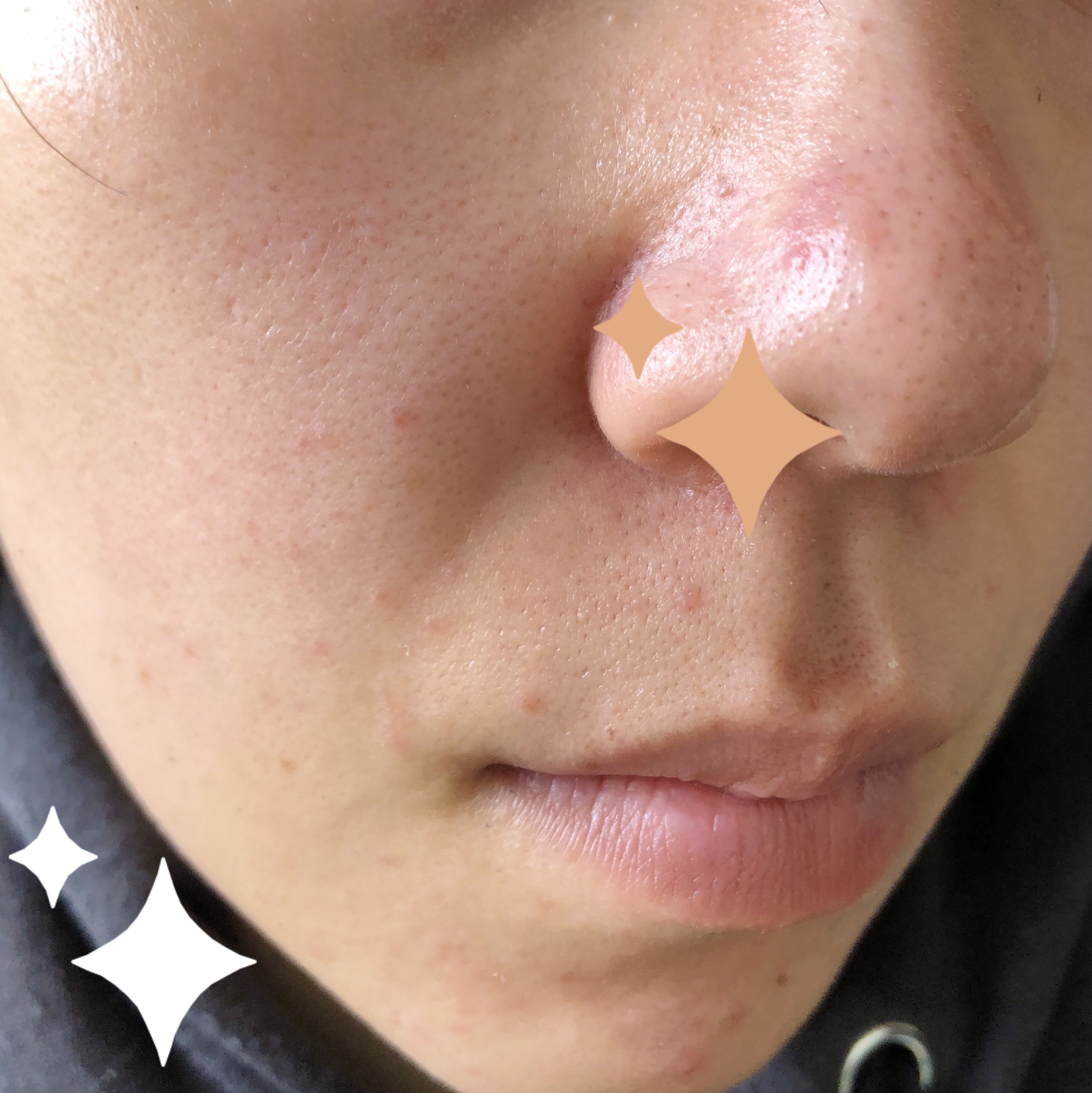 毛穴小町 酵素クレンジングオイル/ソフティモ/オイルクレンジングを使ったクチコミ（3枚目）