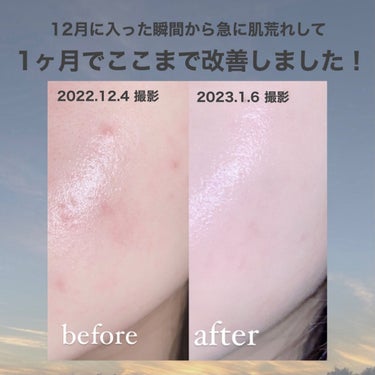 はるかの美容垢🐰 on LIPS 「【ニキビに悩んでる人集合】やーっとやっとニキビについての投稿ま..」（2枚目）