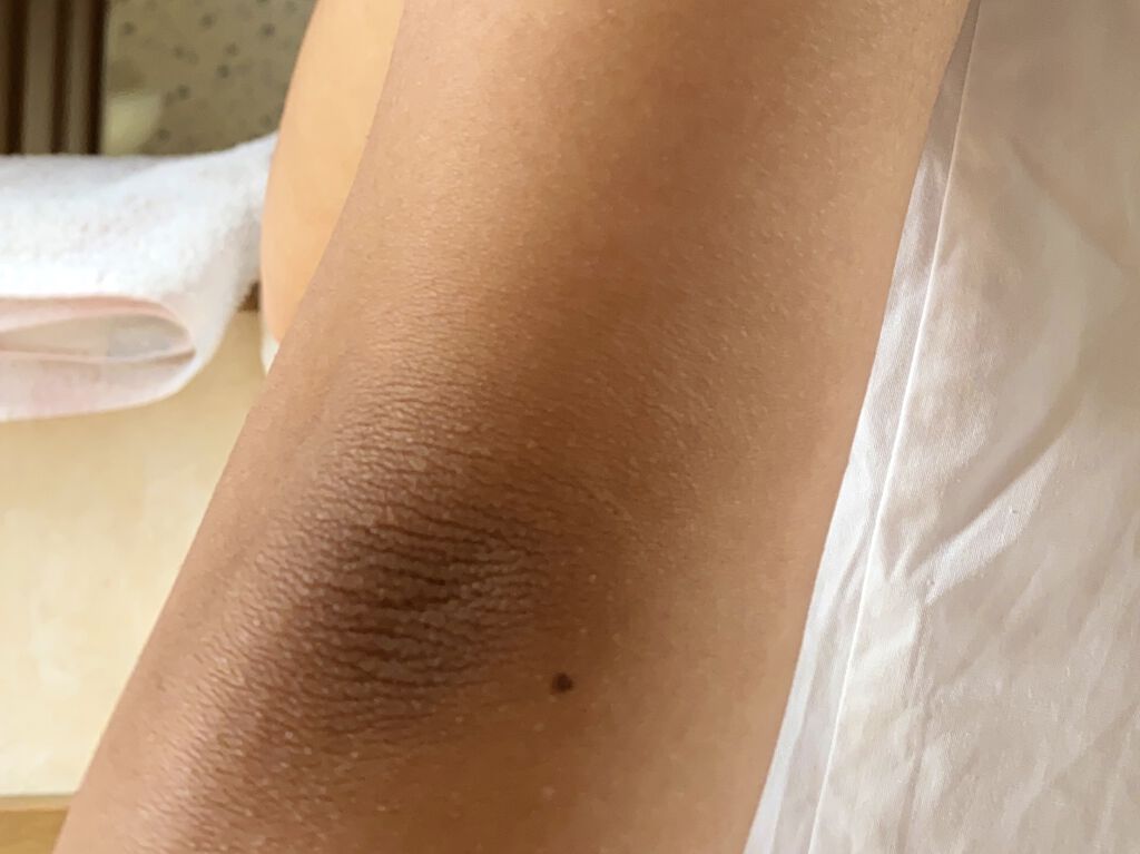 ニベアクリーム ニベアを使った口コミ ひじ 膝の黒ずみケア 1週間チャレン By ঌｓａｒａｓａ໒ 敏感肌 10代後半 Lips