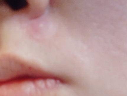 プロCICA クリアスポットパッチ/VT/その他スキンケアを使ったクチコミ(4枚目)