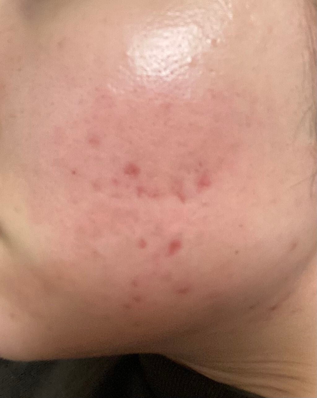 ra on LIPS 「7月19日お風呂上がりでスキンケアしてべピオゲル塗って1時間後..」(2枚目)