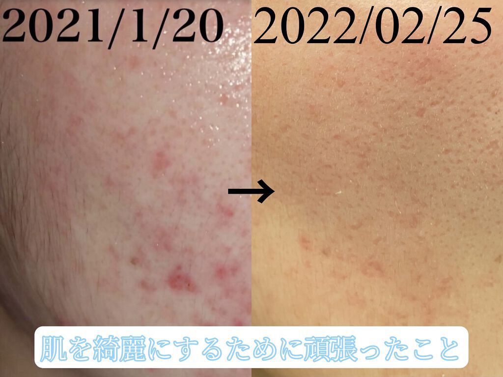 バランスケア エマルジョン MB 100ml(レフィル)/d プログラム/乳液を使ったクチコミ（1枚目）