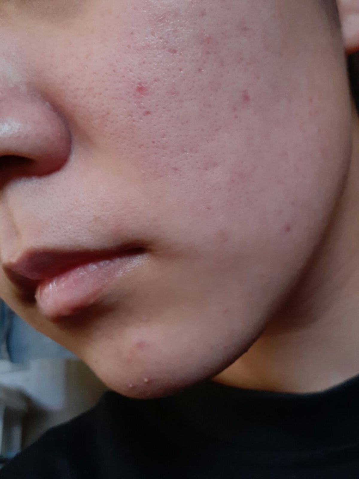 薬用 しみ 集中対策 美容液/メラノCC/美容液を使ったクチコミ(1枚目)