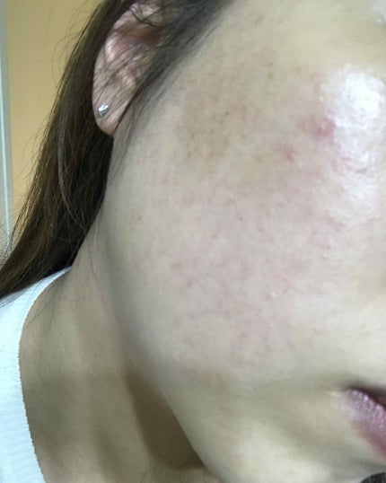 アレルバリア エッセンス BB/d プログラム/BBクリームを使ったクチコミ(3枚目)