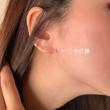 あこ❀ on LIPS 「17skin高濃度ビタミンC（2000mg配合）美容皮膚科医院..」（4枚目）