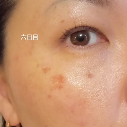 ビヨンセ奥二重向上委員長🥸LIPSパートナー🥳 on LIPS 「ついに!!この時が🤣🩷シミ取りレーザー全記録です🙌🙌🙌(五日目..」(8枚目)