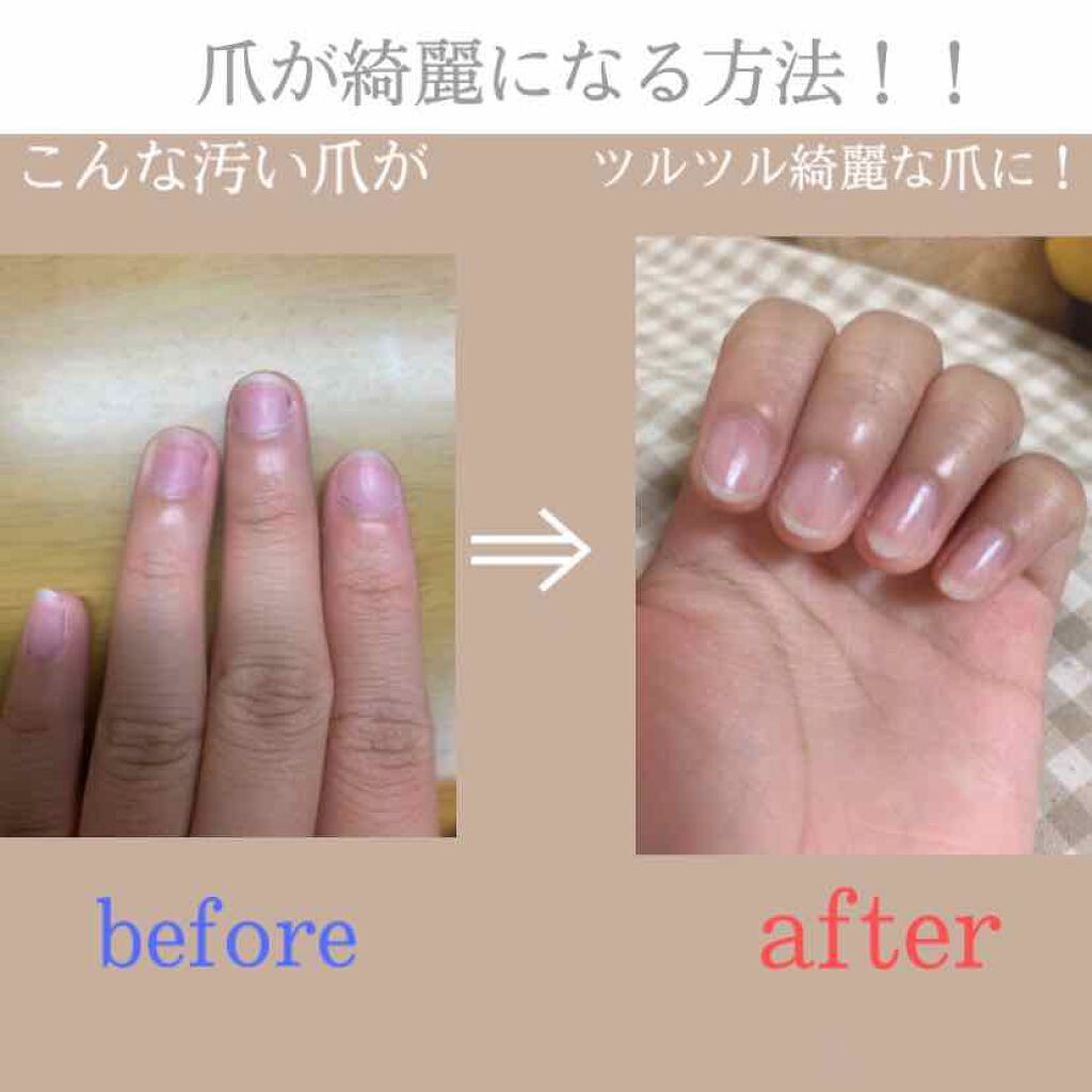 オイルインキューティクルプッシャーペン ビューティーワールドを使った口コミ 汚い爪を綺麗にしたい方必見 こんにち By ジェリーがりこ 乾燥肌 10代後半 Lips