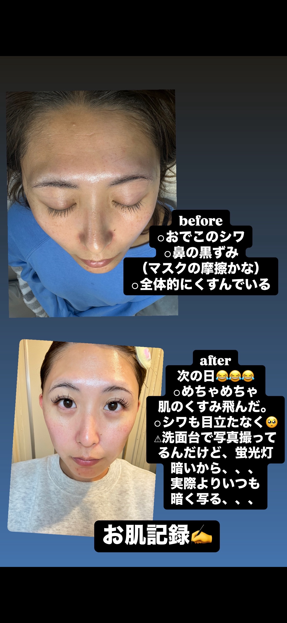 
美容記録✎‪·͜·⋆꙳

❤️‍🔥ハーブピーリング🌿

最近流行っているハーブピーリング🌿初体験

ちょっとチクチクするくらいで
全然痛くなかった🩷
1回しかやってないけど1回で効果感じられて
満足♡♡

1枚目の写真は、
やる前