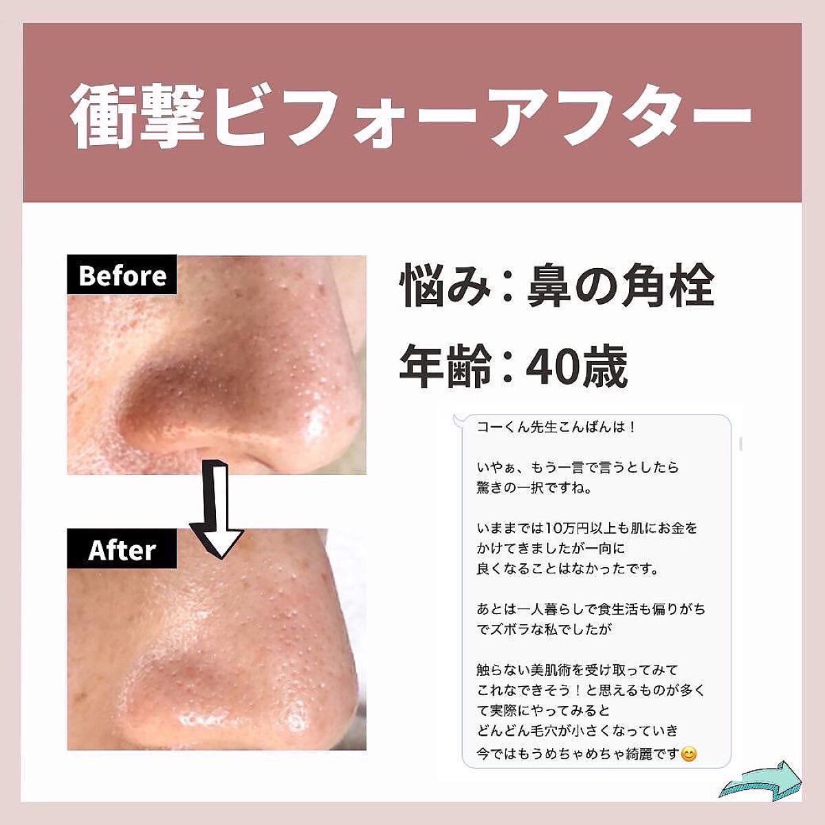 あなたの肌に合ったスキンケア💐コーくん先生 on LIPS 「1月中に鼻の角栓をなくしたい人だけ見てください。.あなたの毛穴..」(2枚目)
