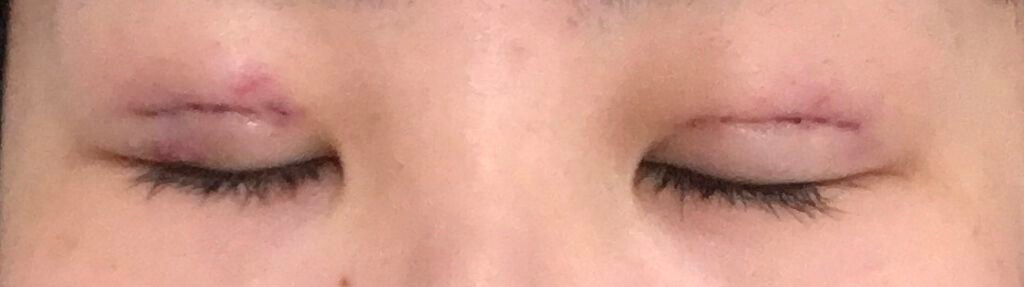 さにょん🍎 on LIPS 「③整形後1日目です。なんだか当日よりも痛々しく😥昨日はなかった..」(2枚目)