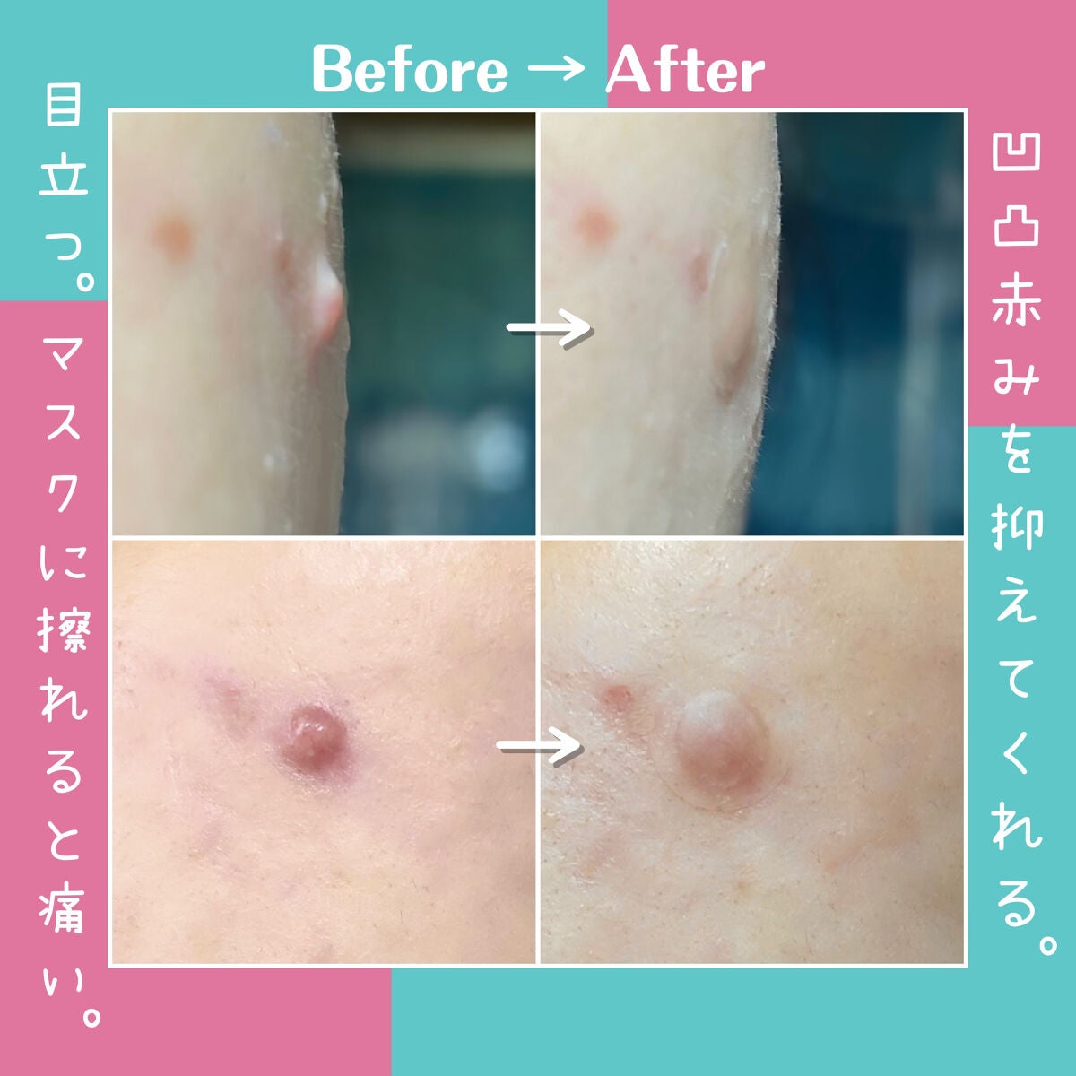 ゼロスポットパッチ/Today’s Cosme/にきびパッチを使ったクチコミ(5枚目)