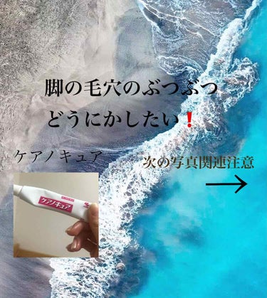 脚のぶつぶつがすごく困ってて見つけたのがこのケアのキュア。私が買った時の値段は1400円くらいでした！

二枚目の写真は一本使い切り二本目突入したときのBefore afterです。

毎日2、3回塗り