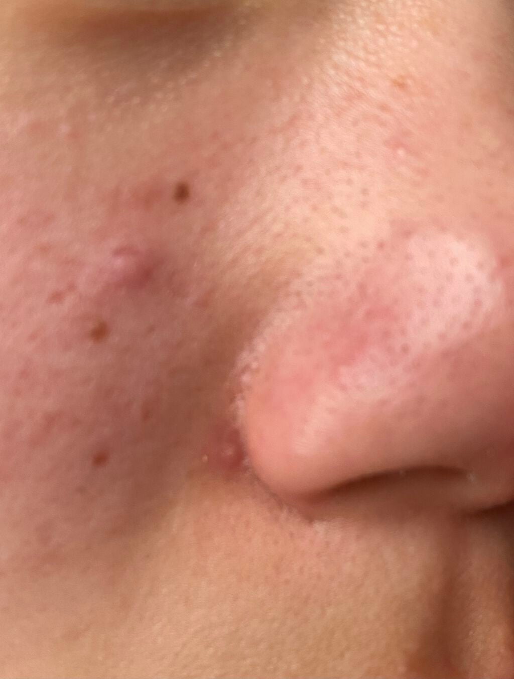 豚の子 on LIPS 「汚い肌です‼️‼️‼️頬は赤くなりますし毛穴はとても目立ちます..」(2枚目)