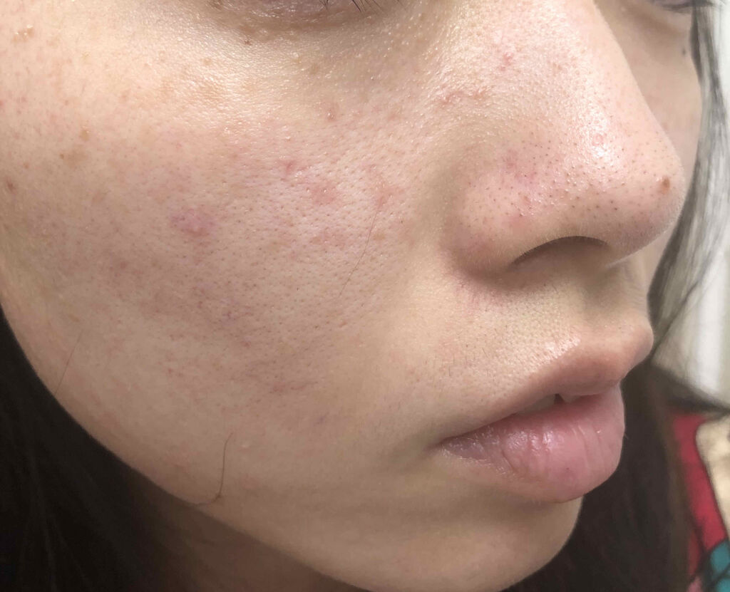 薬用 しみ 集中対策 美容液/メラノCC/美容液を使ったクチコミ（3枚目）