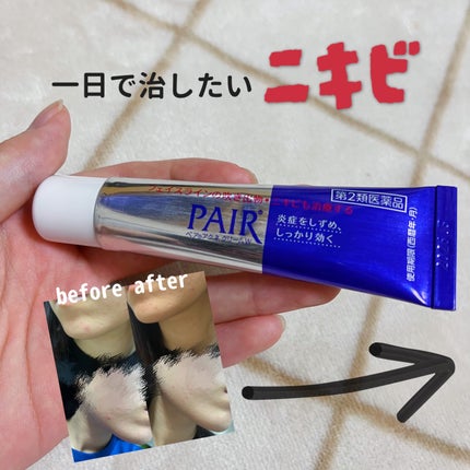 ペアアクネクリームW(医薬品)/ペア/その他を使ったクチコミ(1枚目)