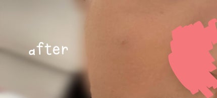 フィットミー コンシーラー/MAYBELLINE NEW YORK/リキッドコンシーラーを使ったクチコミ(4枚目)