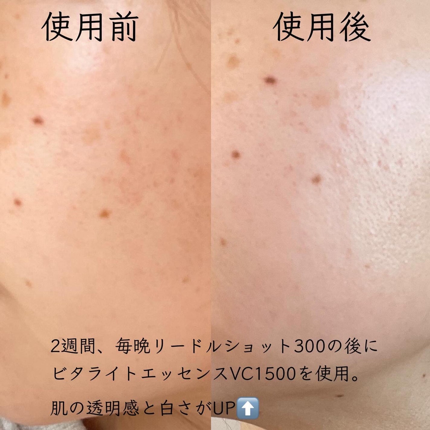 リードルショット300/VT/美容液を使ったクチコミ(4枚目)