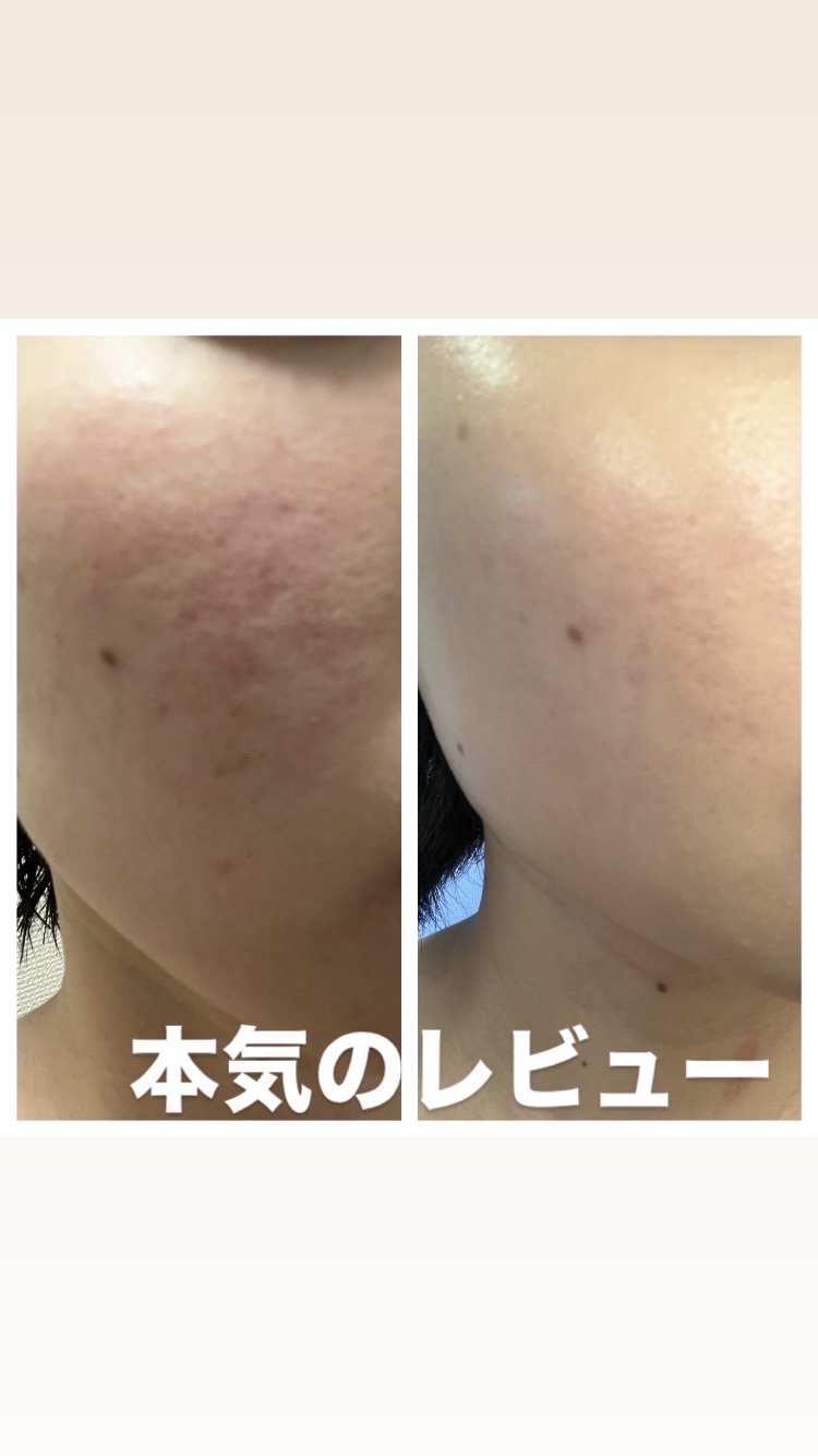 補中益気湯エキス錠クラシエ（医薬品）/クラシエ薬品/その他を使ったクチコミ（1枚目）