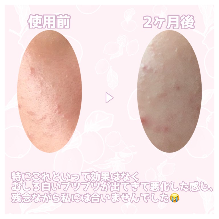 アクネキュアクリーム(医薬品)/IHADA/その他を使ったクチコミ(4枚目)