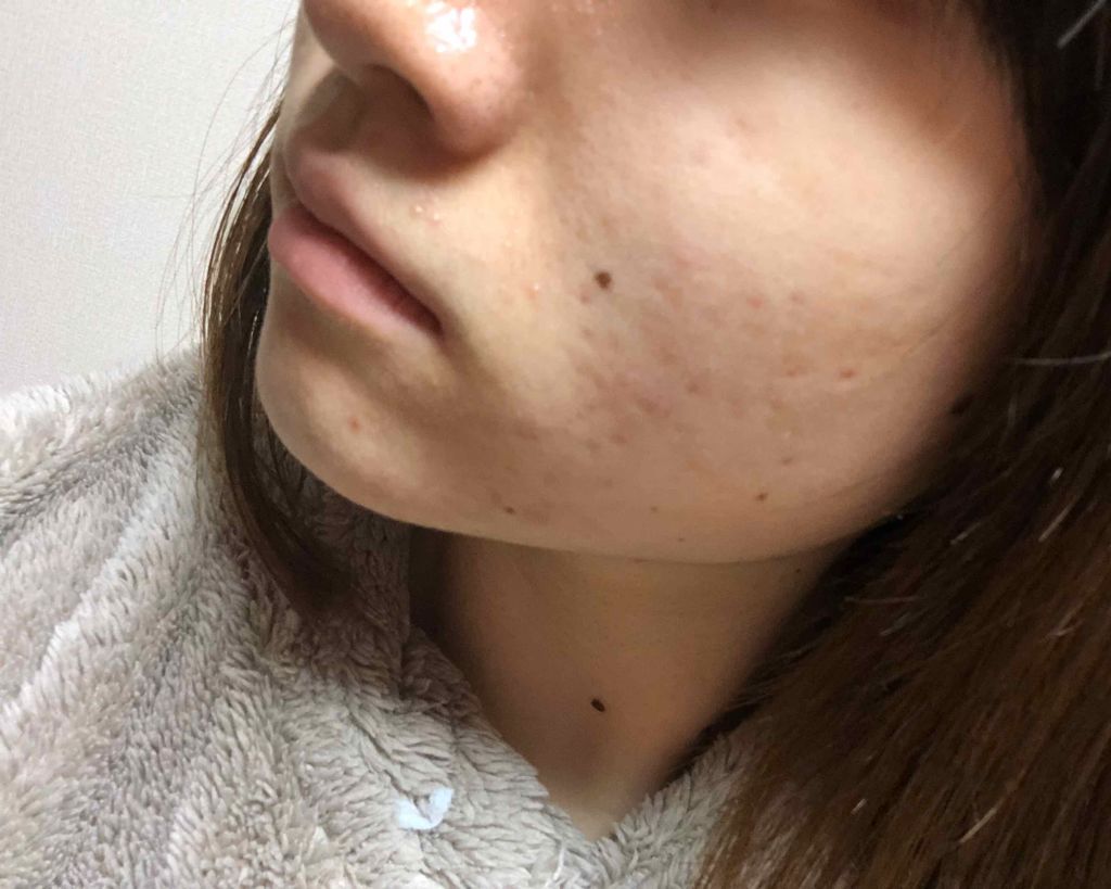 マンスリースキンケアプログラム(旧)/APEX/スキンケアキットを使ったクチコミ(4枚目)