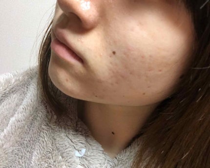 マンスリースキンケアプログラム(旧)/APEX/スキンケアキットを使ったクチコミ(4枚目)