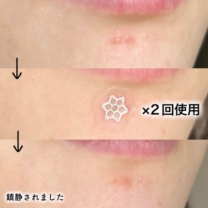 ACマグネシウムパッチ ミニ/スノーツープラス/にきびパッチを使ったクチコミ(5枚目)