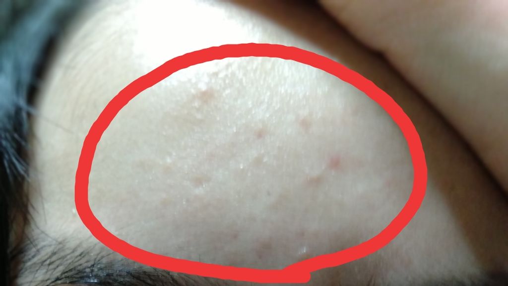 薬用3ステップセット30日サイズ/プロアクティブ/トライアルキットを使ったクチコミ(4枚目)