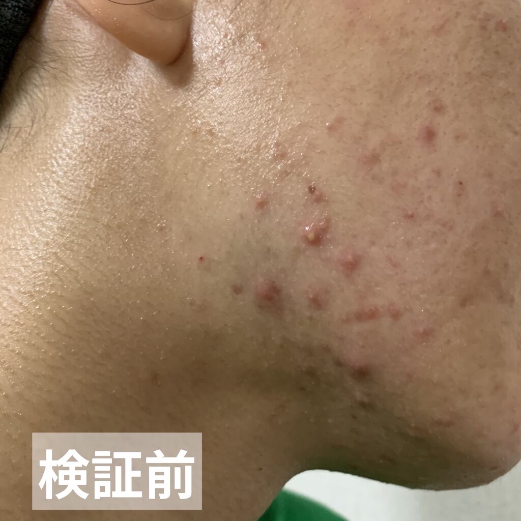 ペアアクネクリームW(医薬品)/ペア/その他を使ったクチコミ（2枚目）