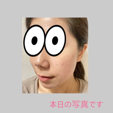 mii on LIPS 「汚肌日記✂ーーーーーーーーーーーーーーーーーーーーこんばんは✨..」（3枚目）