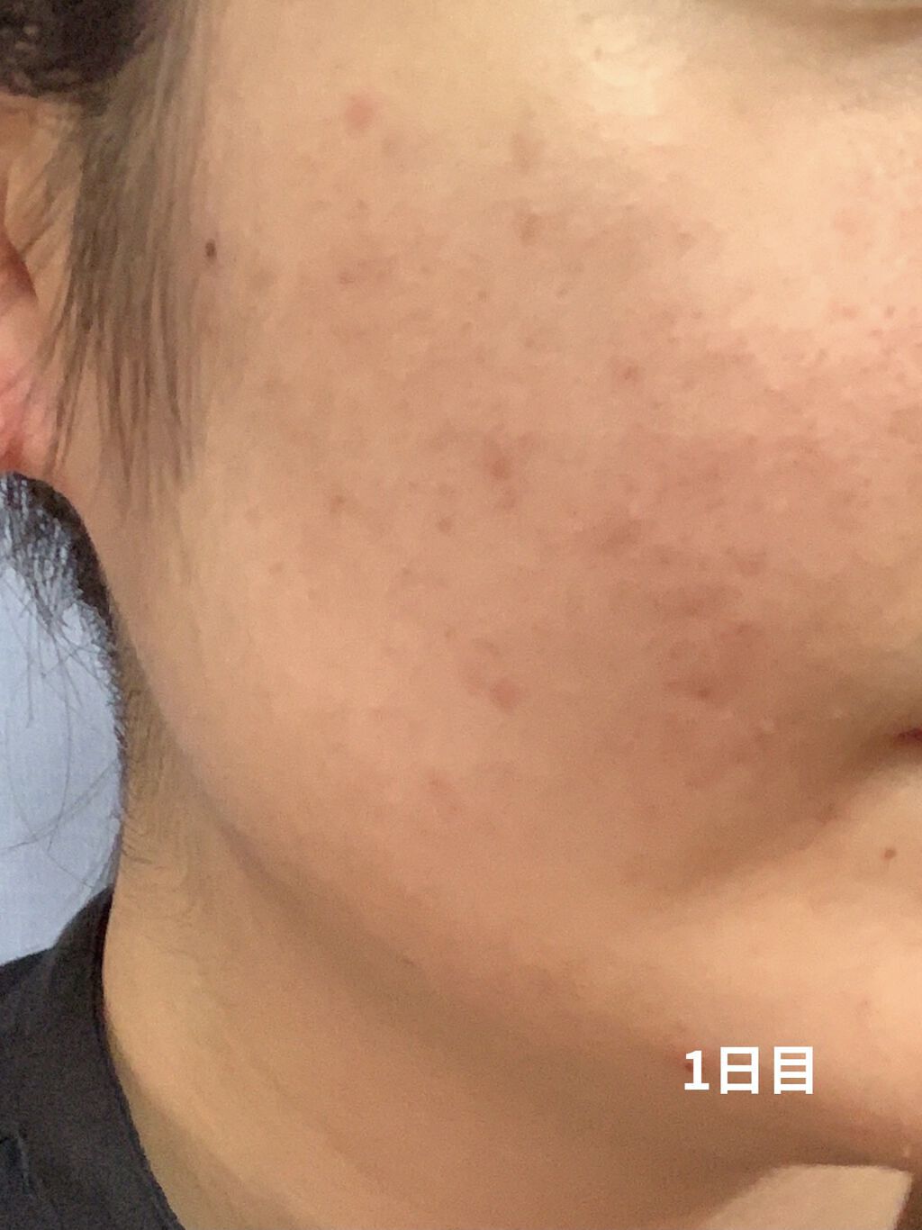 アクネキュアクリーム(医薬品)/IHADA/その他を使ったクチコミ（2枚目）