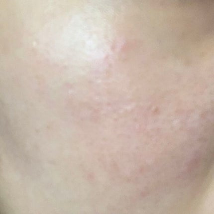 薬用 しみ 集中対策 美容液/メラノCC/美容液を使ったクチコミ(2枚目)