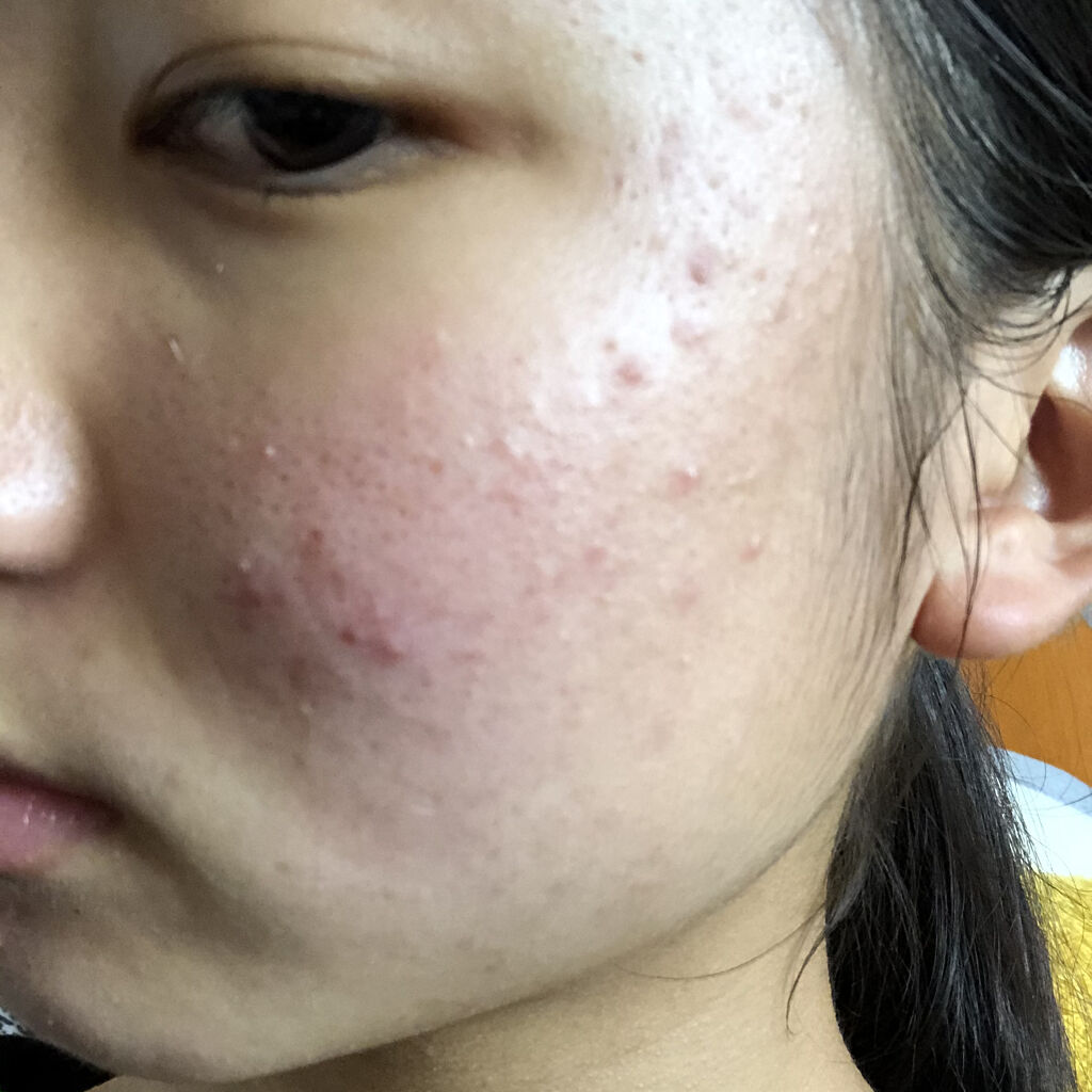 モイスチュア ローション/カルテHD/化粧水を使ったクチコミ（1枚目）