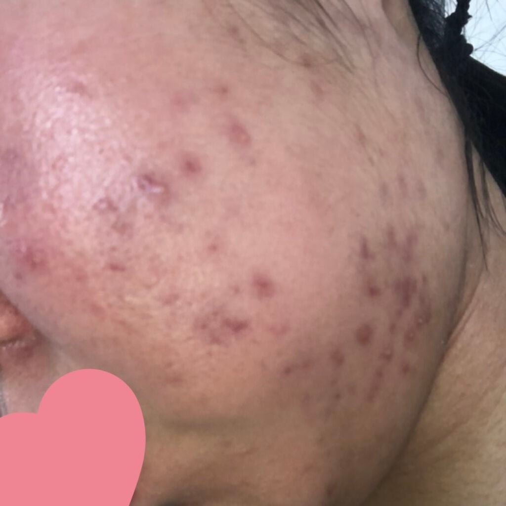 ハトムギ化粧水(ナチュリエ スキンコンディショナー R )/ナチュリエ/化粧水を使ったクチコミ(2枚目)