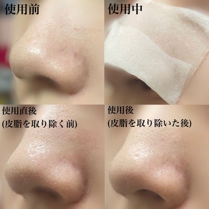 アクレオンセボエクストラクター/ANACIS/その他スキンケアを使ったクチコミ(4枚目)