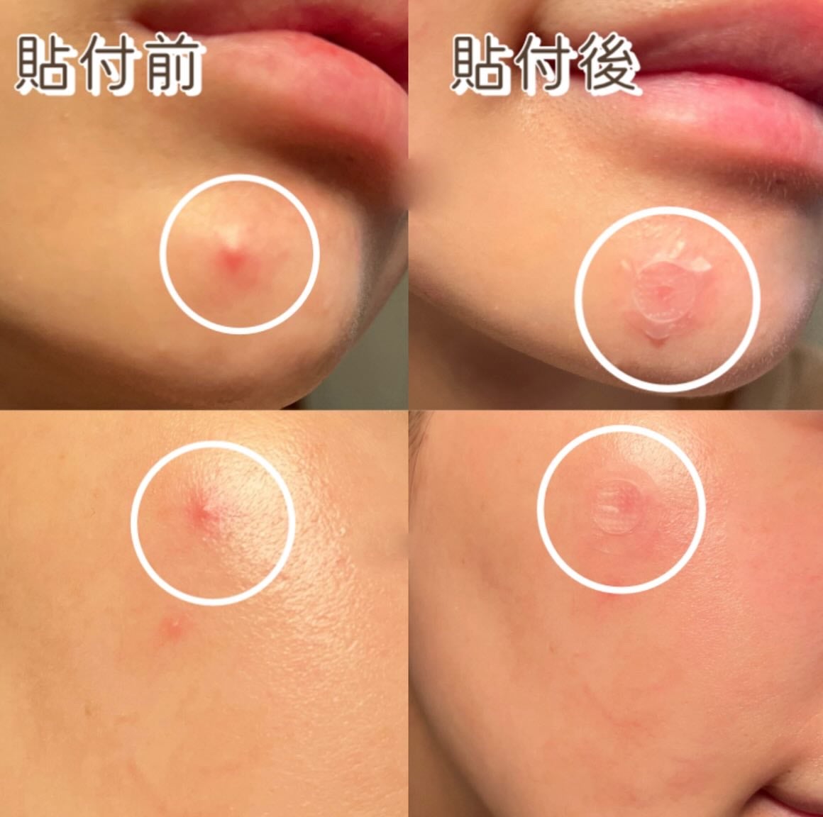 クイックカーミング パッチ/イージーダムビューティー/その他スキンケアを使ったクチコミ(6枚目)