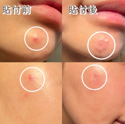 クイックカーミング パッチ/イージーダムビューティー/その他スキンケアを使ったクチコミ(6枚目)