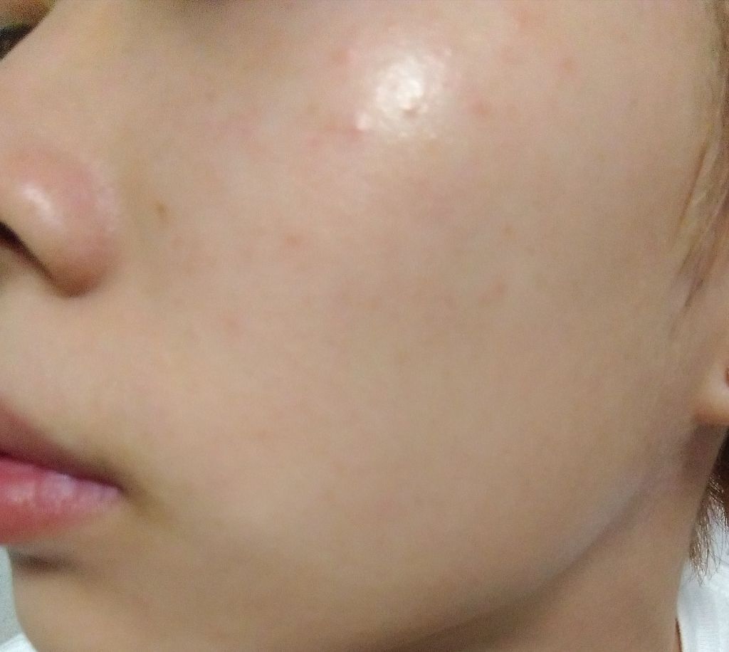 薬用 しみ 集中対策 美容液/メラノCC/美容液を使ったクチコミ(1枚目)