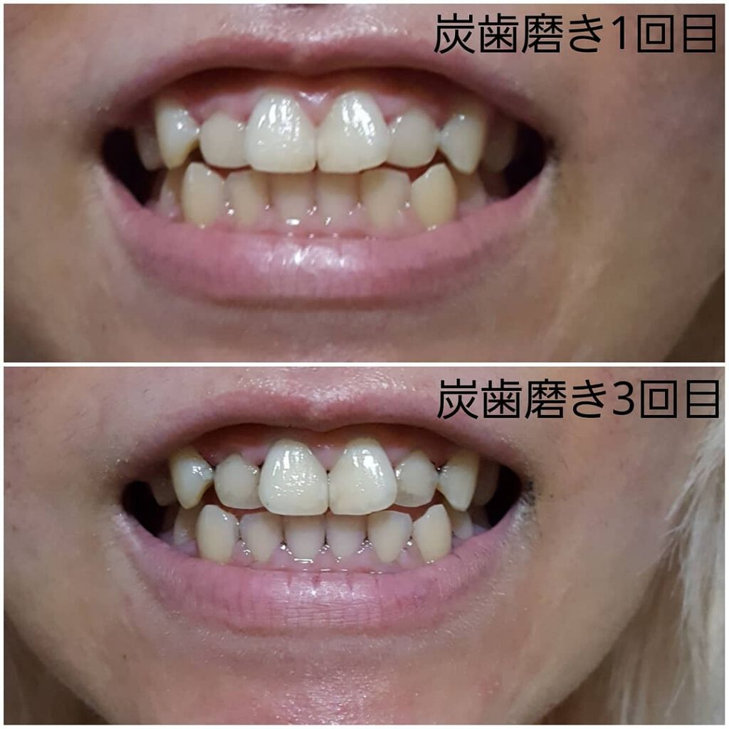 チャコールパーティクル/Charcoal particle/健康サプリメントを使ったクチコミ(2枚目)