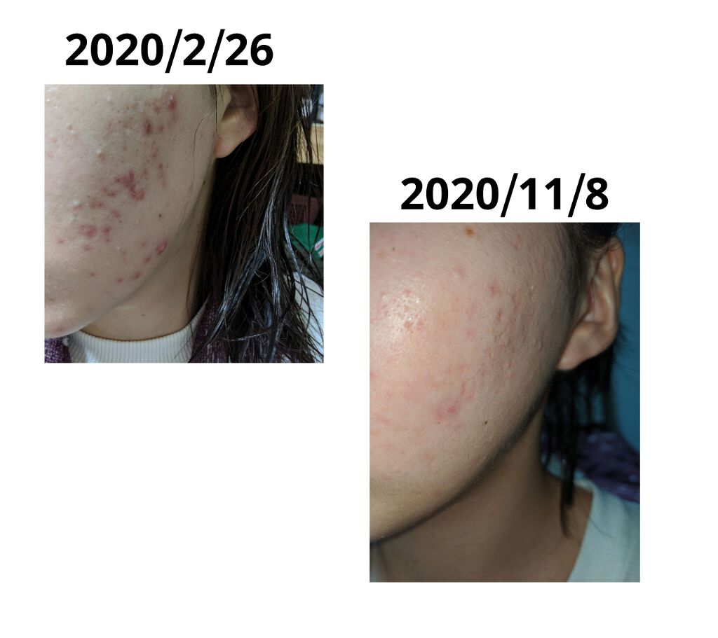 DHC はとむぎエキス/DHC/健康サプリメントを使ったクチコミ(1枚目)