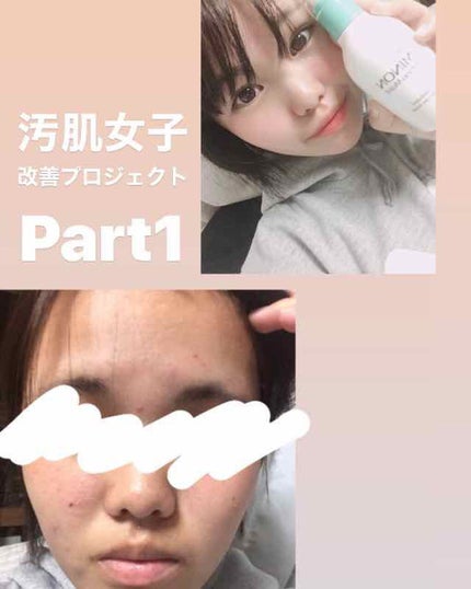 ミノン アミノモイスト 薬用アクネケア ローション/ミノン/化粧水を使ったクチコミ(1枚目)
