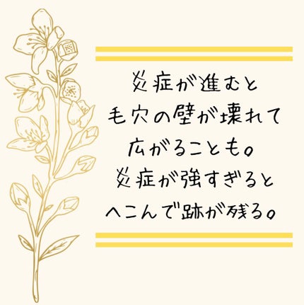 Mii on LIPS 「ニキビを作らないためには❶汚れを放置しない (必ずメイクを落と..」(9枚目)